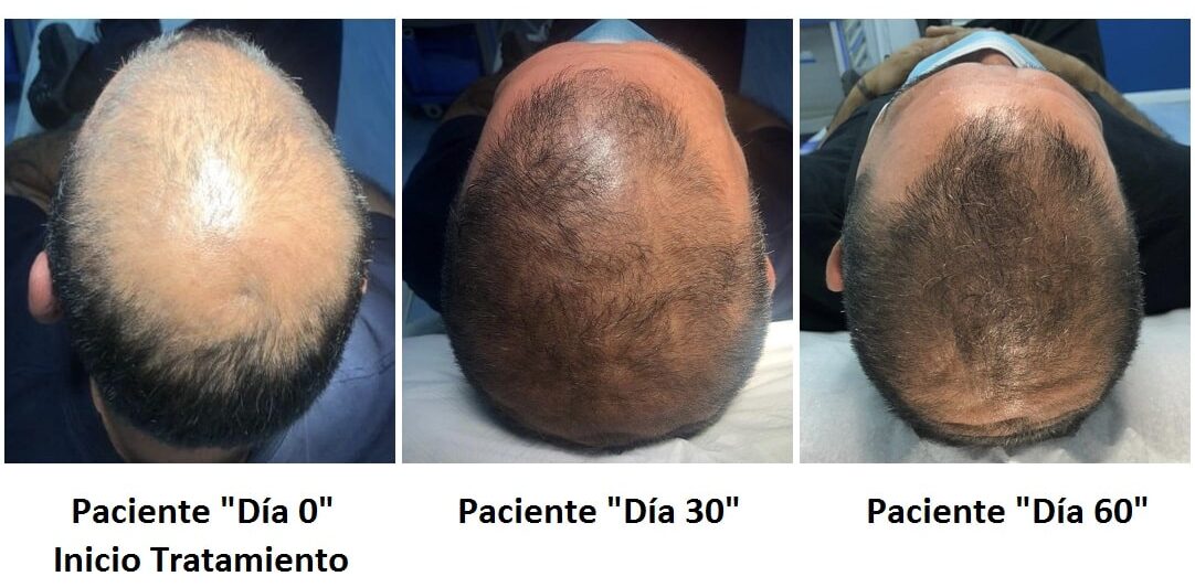 tratamiento de alopecia