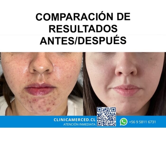Acné con tratamiento médico láser en santiago