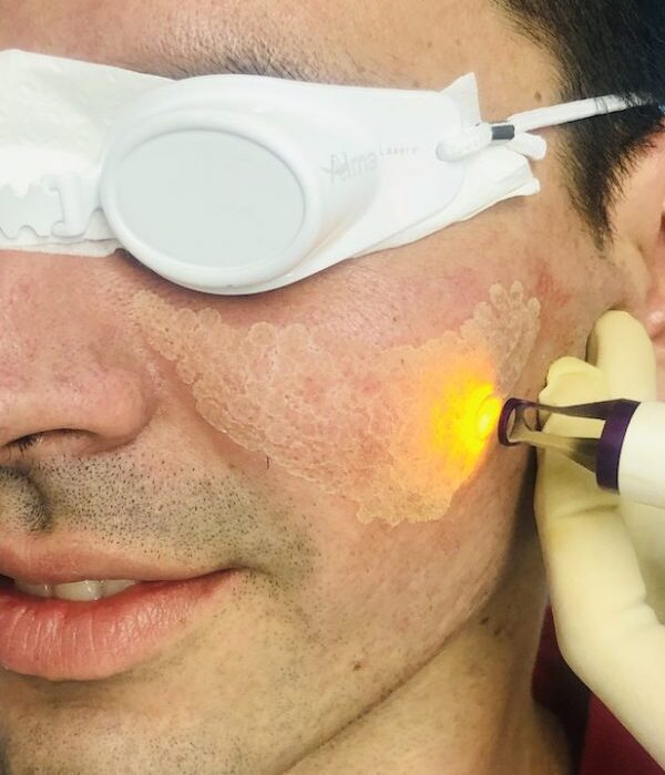 Cicatrices Atróficas Y TRATAMIENTO LÁSER