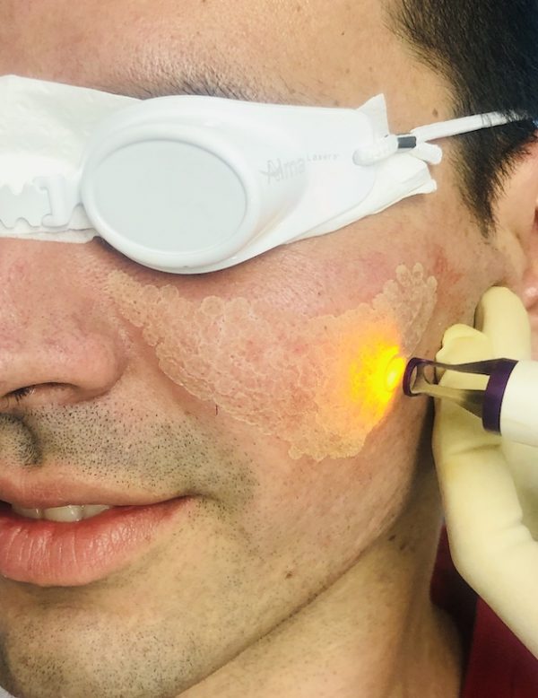 Cicatrices Atróficas Y TRATAMIENTO LÁSER