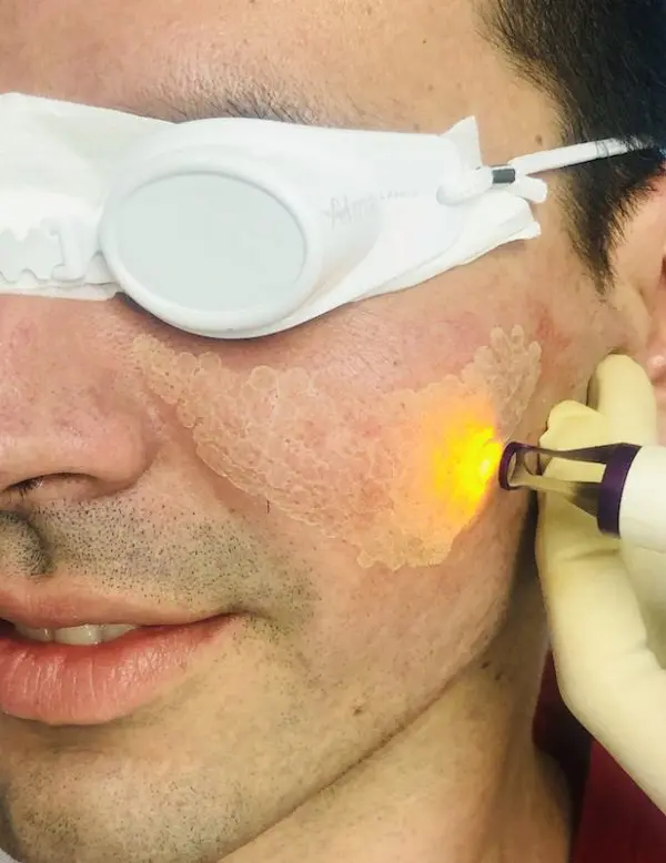 Cicatrices Atróficas Y TRATAMIENTO LÁSER