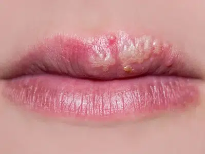 Herpes Labial