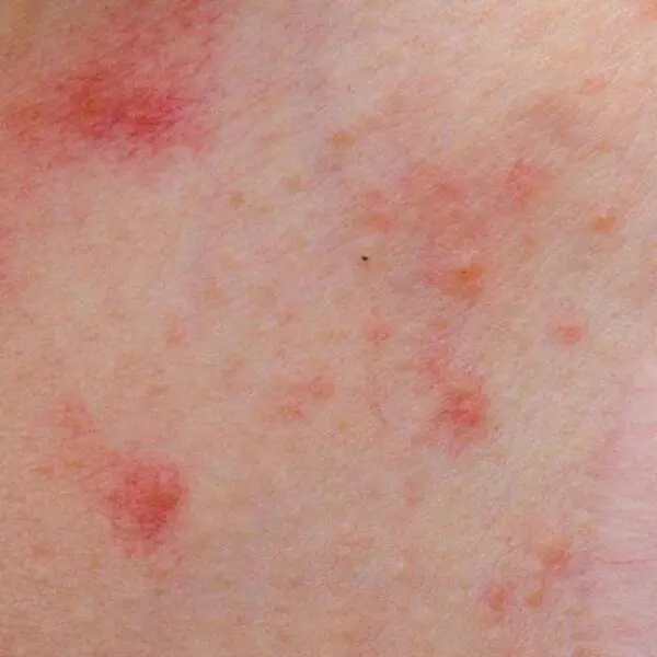 herpes