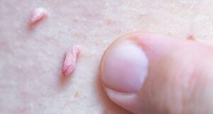 verrugas genitales y tratamiento médico en santiago