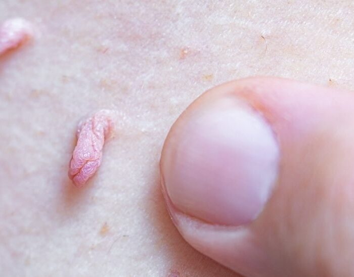 verrugas genitales y tratamiento médico en santiago