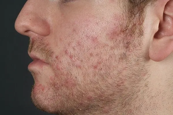 Foliculitis