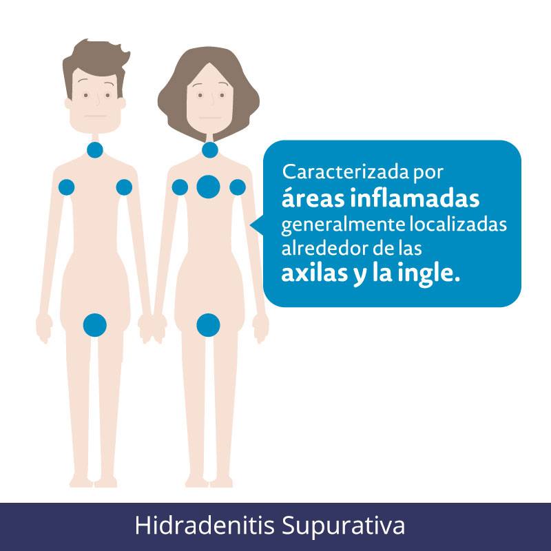 hidradenitis supurativa en glúteos tratamiento médico