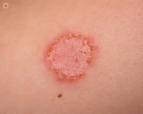 Micosis