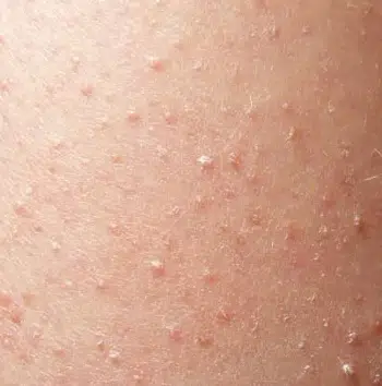 Queratosis Pilaris