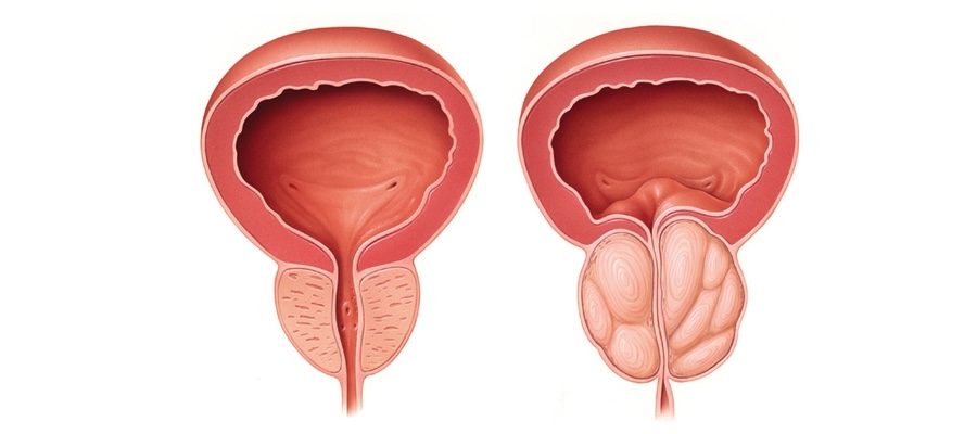 Hiperplasia Prostática Benigna cirugía en santiago
