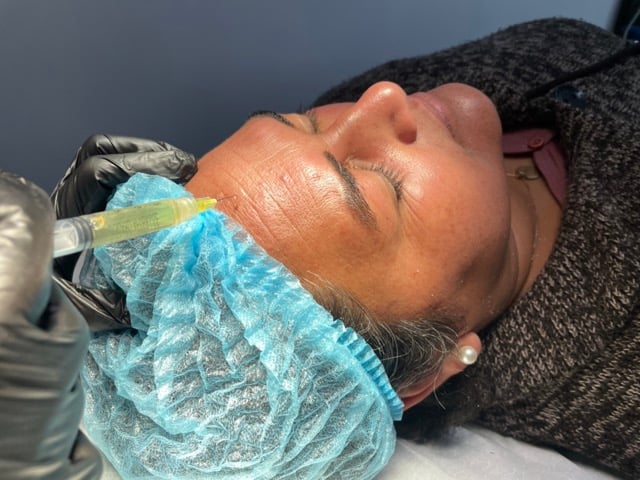 Plasma Rico en Plaquetas para Rejuvenecimiento Facial