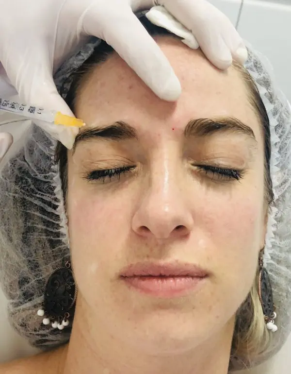 bótox