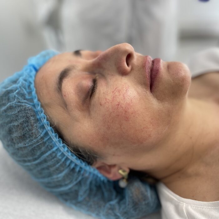 rosácea en mejillas