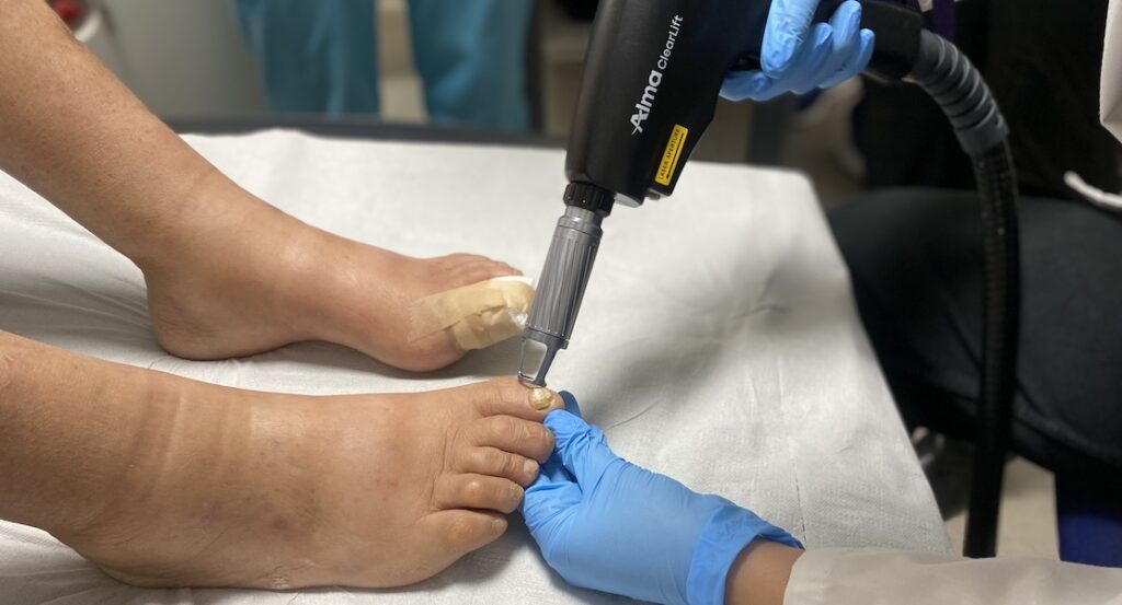 Láser para Hongos en Uñas onicomicosis