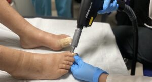 Láser para Hongos en Uñas onicomicosis