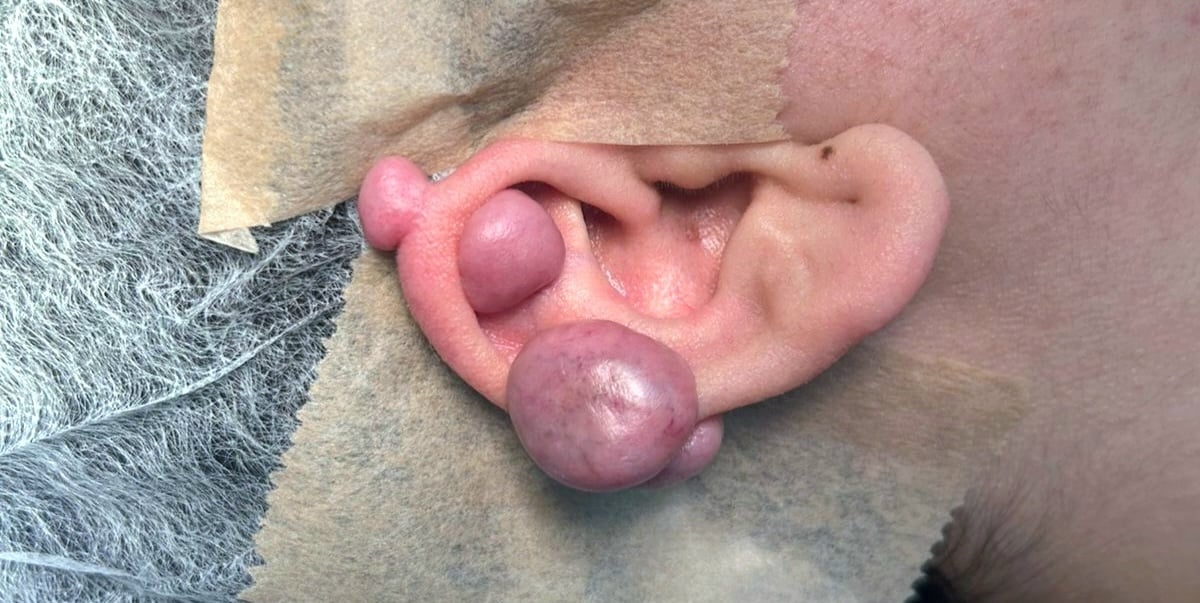 Queloide con solución médica en providencia