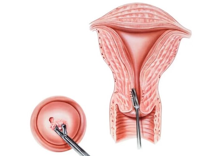 Biopsia de Cuello Uterino EN SANTIAGO