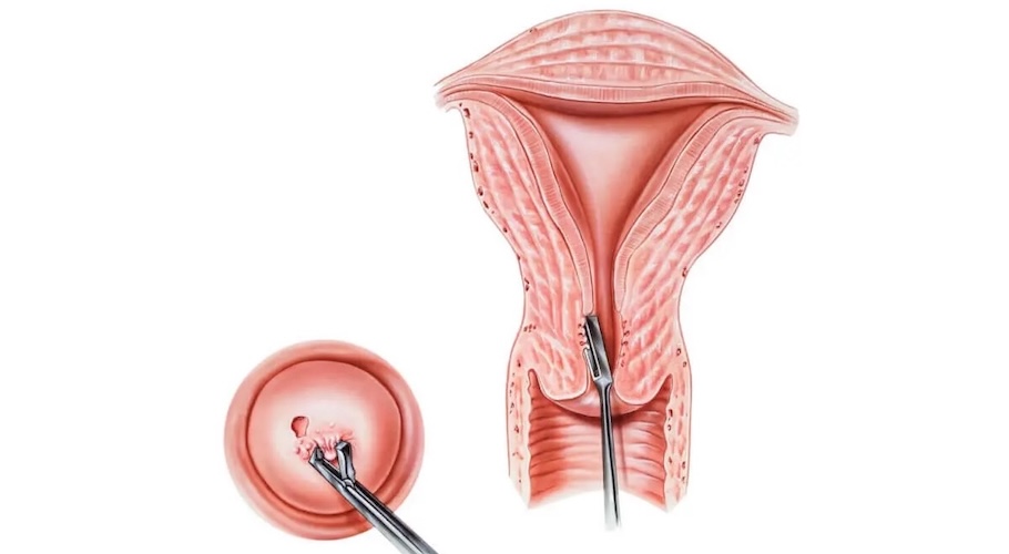 Biopsia de Cuello Uterino EN SANTIAGO