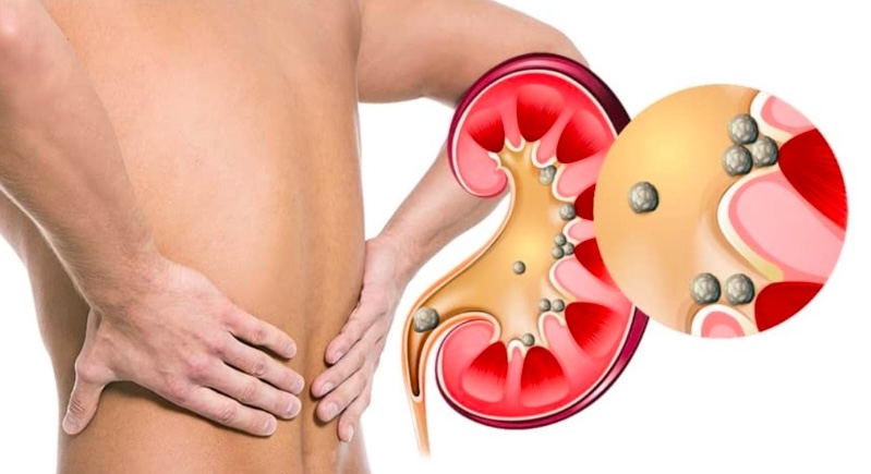 cálculos renales atención de urgencia