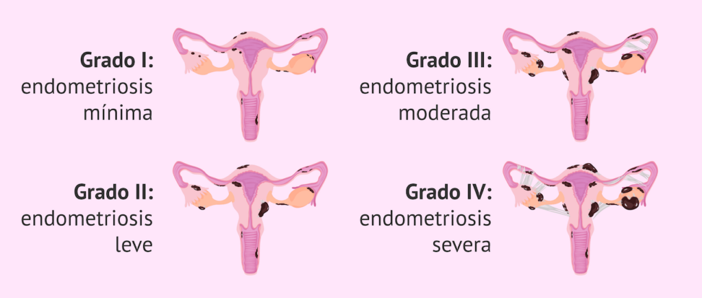 endometriosis médico especialista