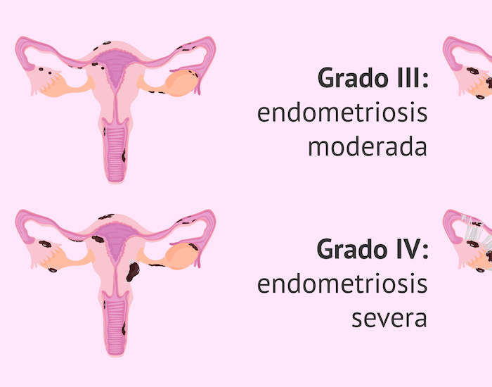 endometriosis médico especialista