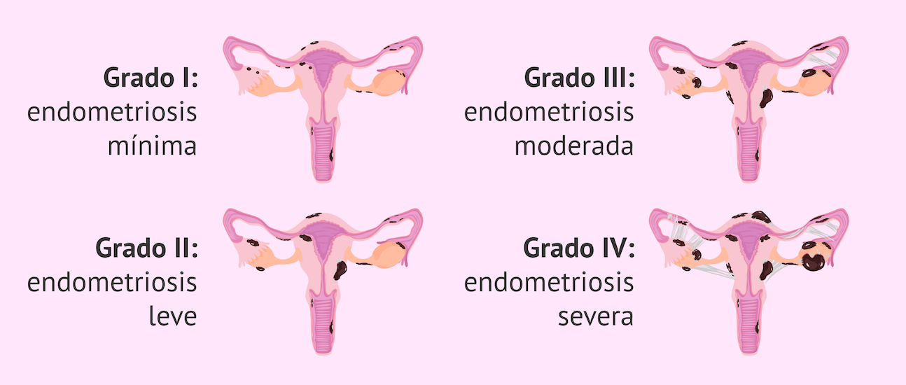 endometriosis médico especialista