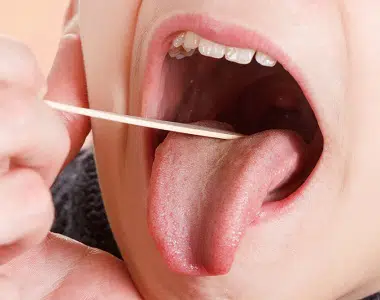 servicio médico, Faringitis Crónica
