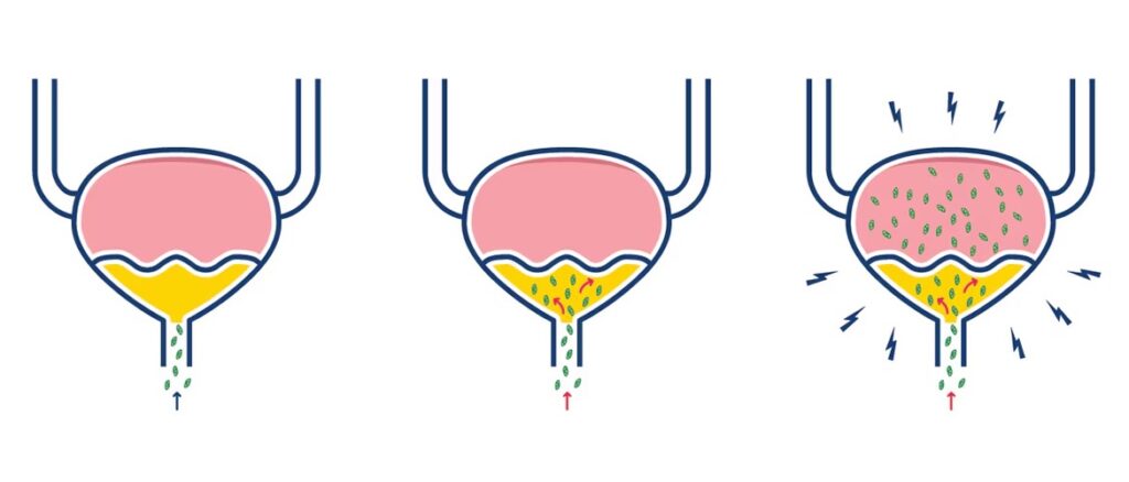 infección de las vías urinarias médico en santiago