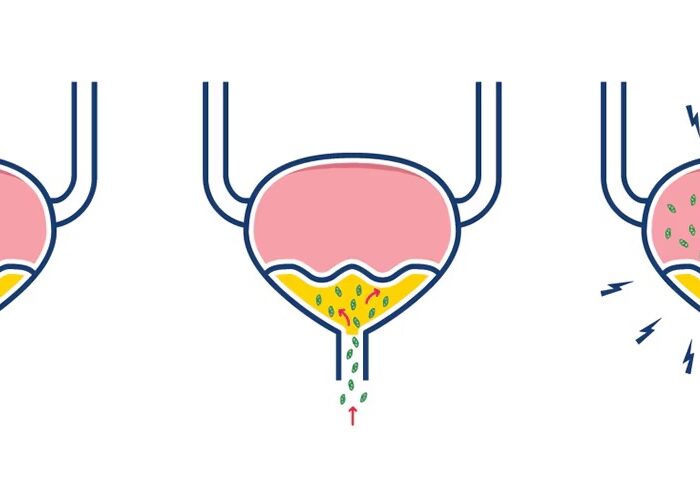 infección de las vías urinarias médico en santiago