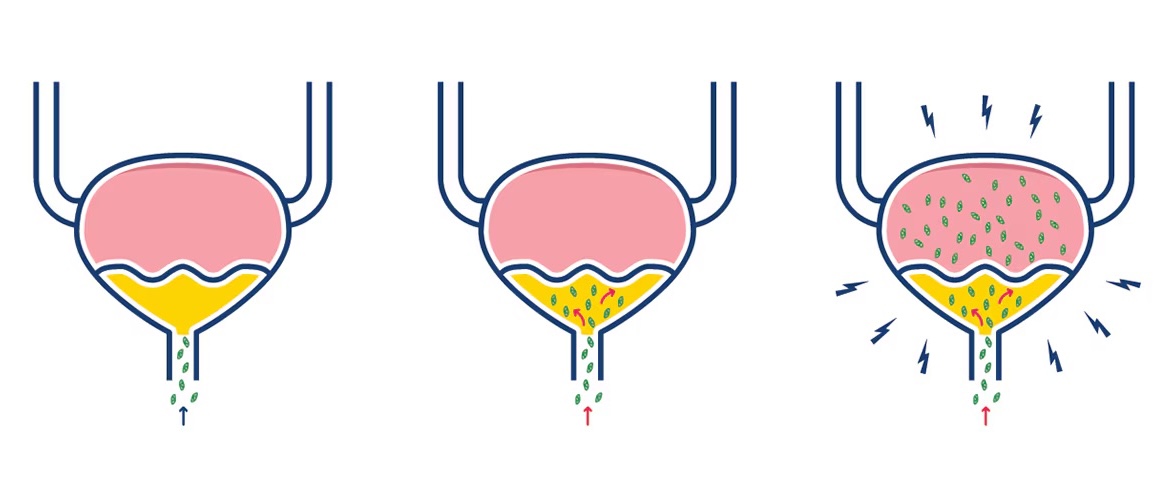 infección de las vías urinarias médico en santiago