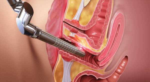 láser para dolor pélvico