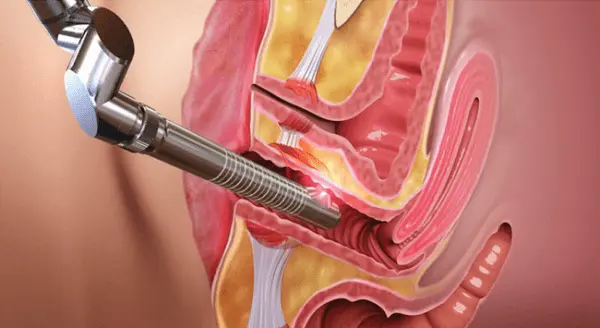 láser para dolor pélvico