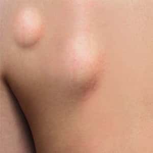 Lipoma