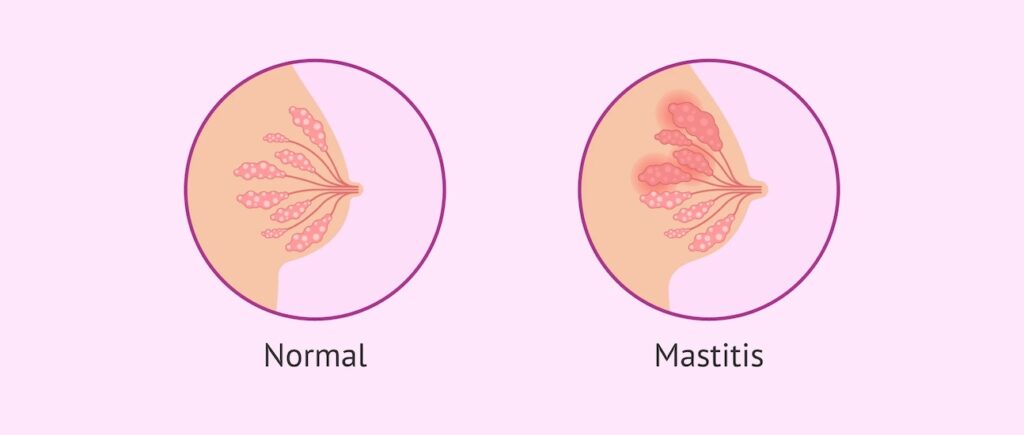 mastitis médico especialista en providencia