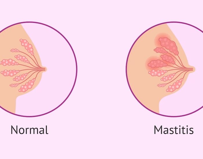 mastitis médico especialista en providencia