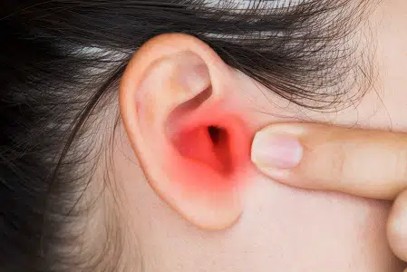 Otitis Externa