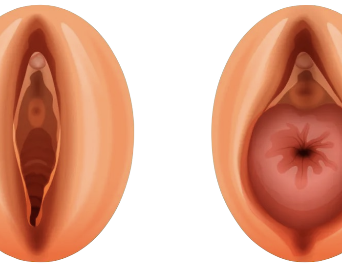 prolapso uterino cirugía en santiago