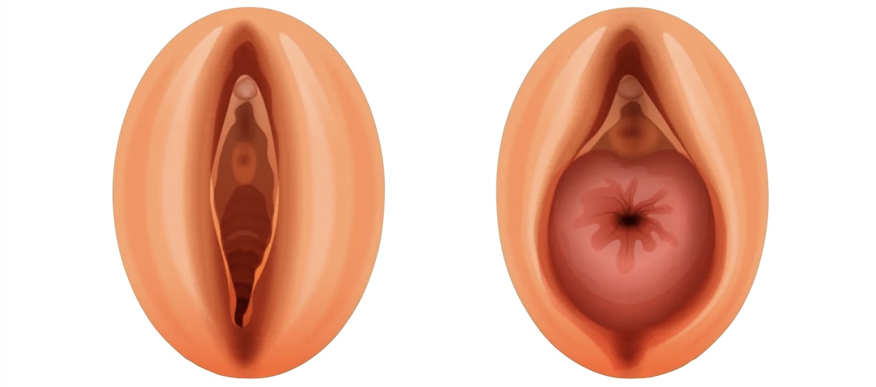 prolapso uterino cirugía en santiago
