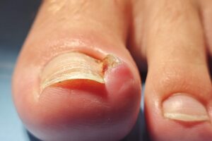 uña encarnada atención médica de urgencia