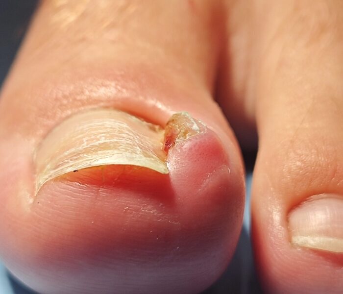 uña encarnada atención médica de urgencia