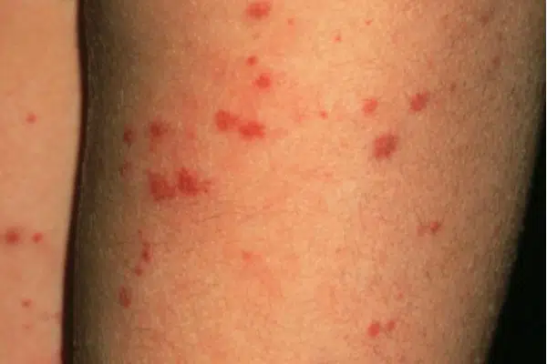 Vasculitis