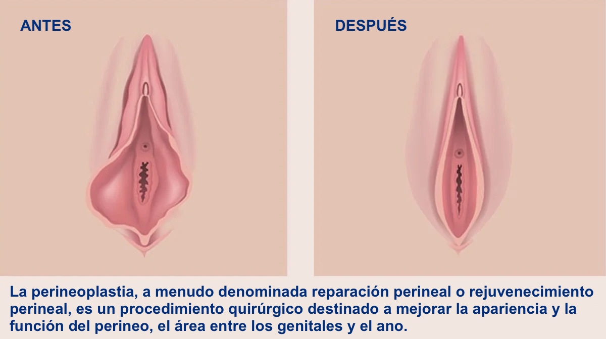 Perienoplastia CON CIRUJANO ESPECIALISTA