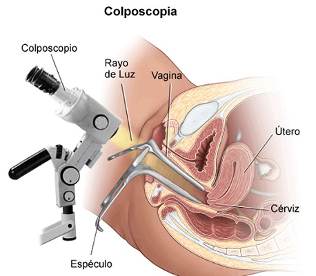 colposcopía