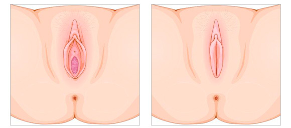 perineoplastia