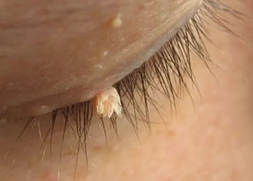 Verrugas en los Ojos