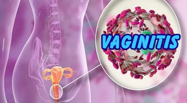 Vaginitis médico especialista urgente
