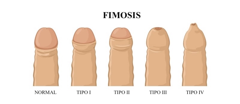 fimosis y cirugía de urgencia