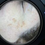 Antes 1 Manchas en el Rostro - Léntigo