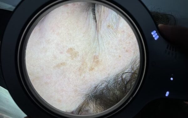 Antes 1 Manchas en el Rostro - Léntigo