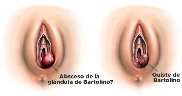 Quiste de Bartolino cirugía de urgencia